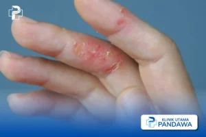 Dermatitis Dishidrotik