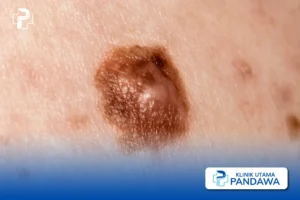 Melanoma