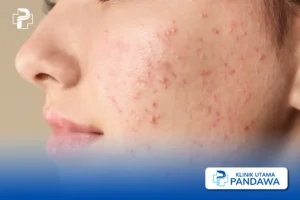 acne vulgaris
