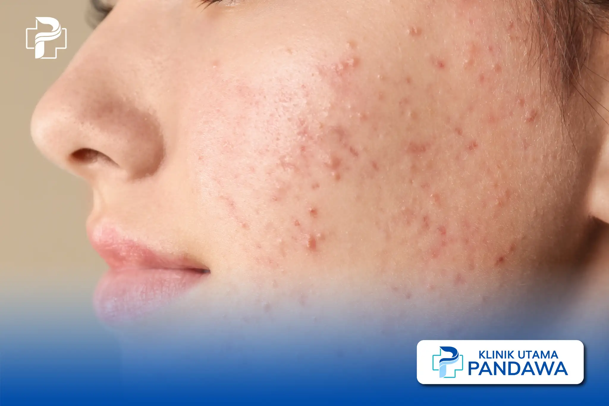 acne vulgaris