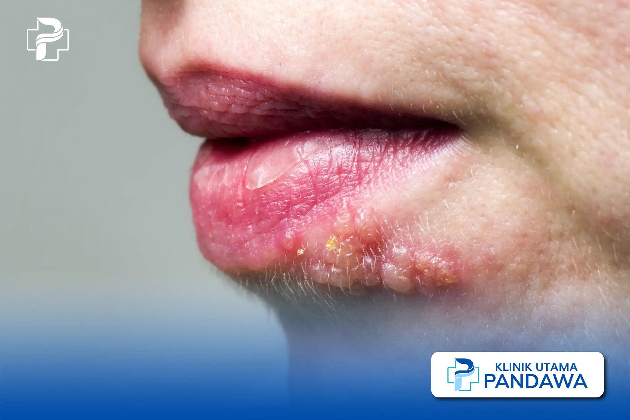 herpes bibir