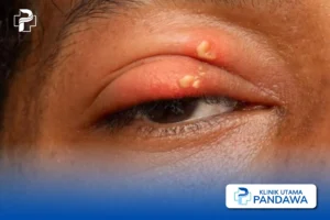 herpes okular