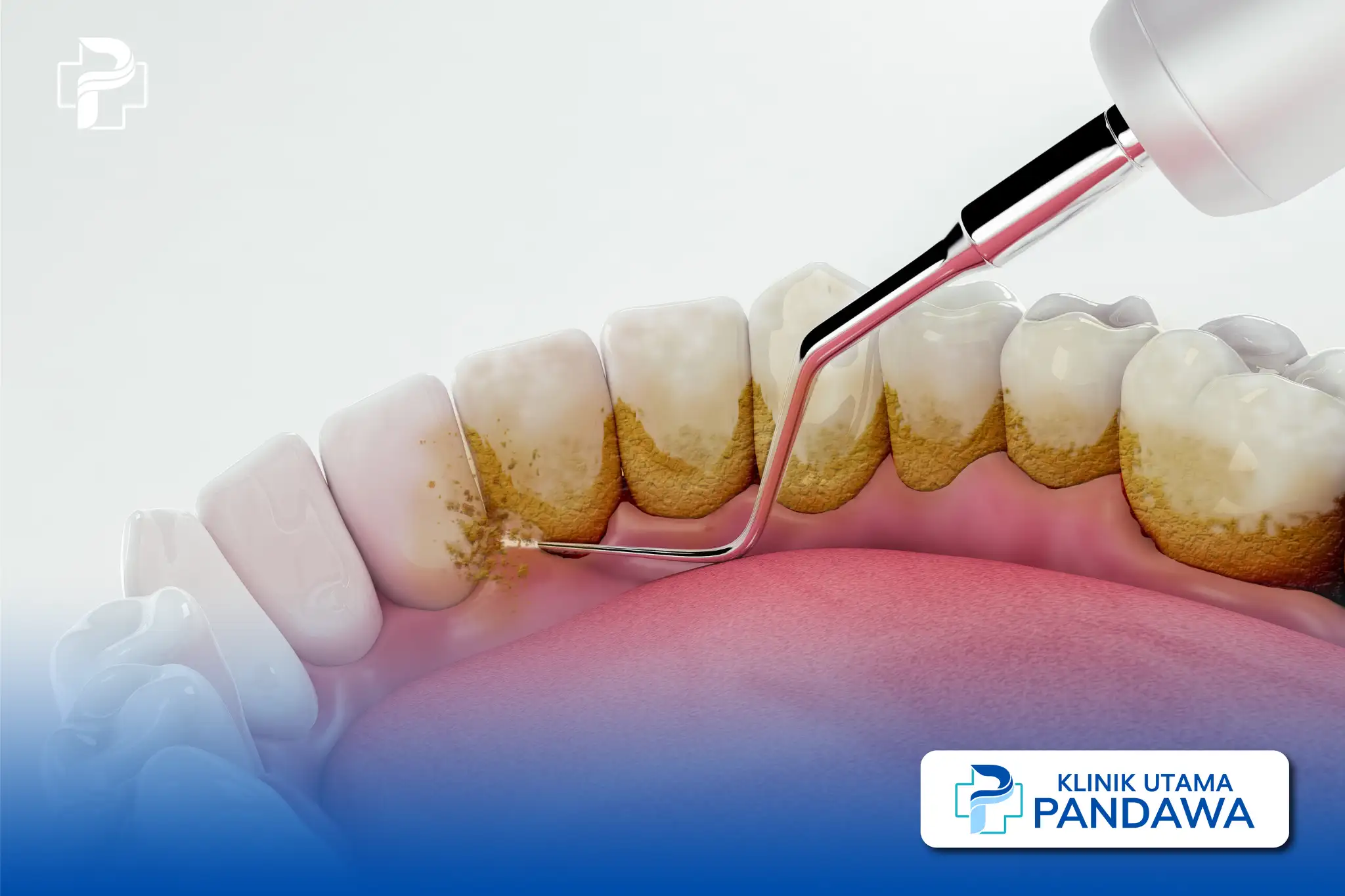 hipoplasia enamel