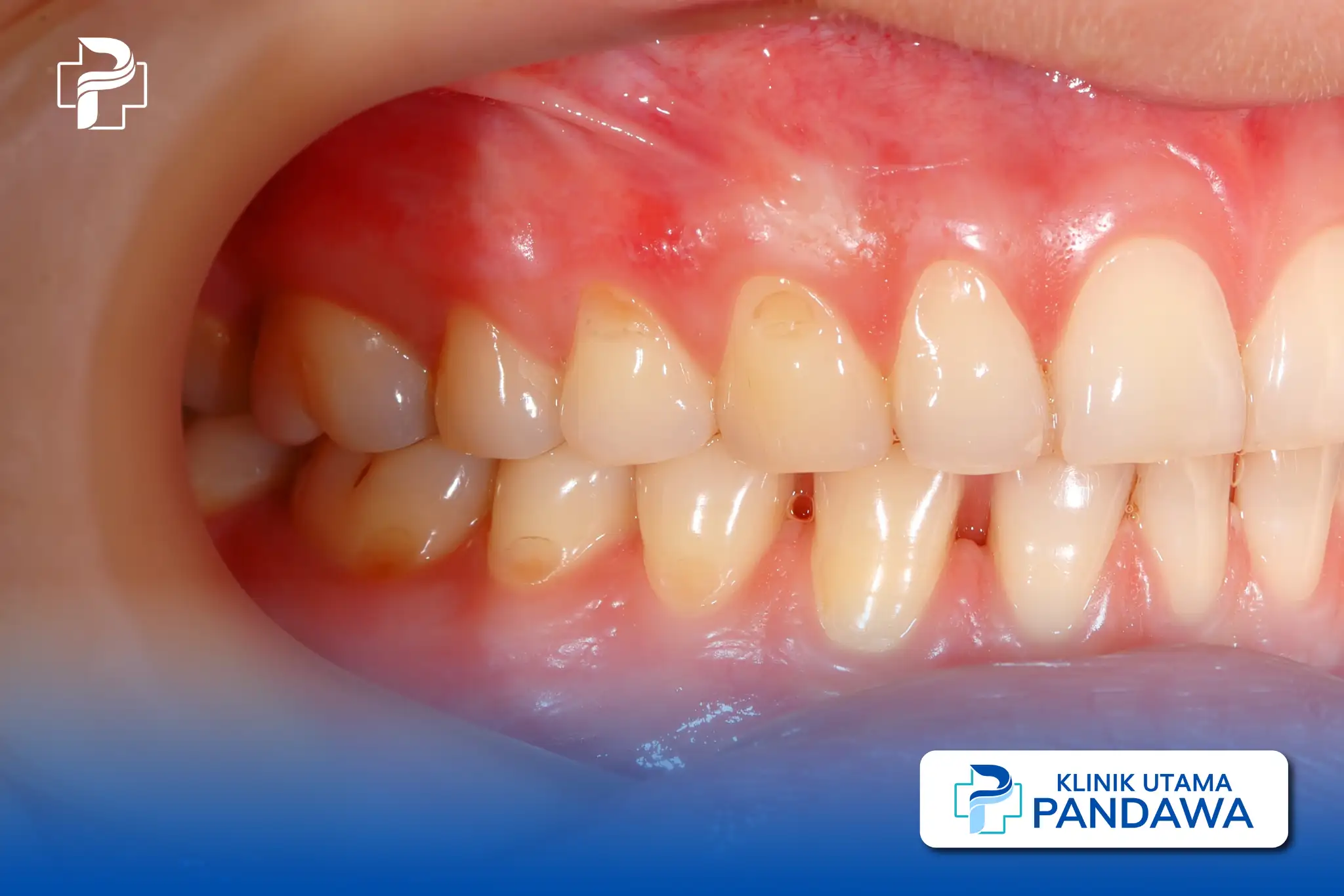 hipoplasia enamel