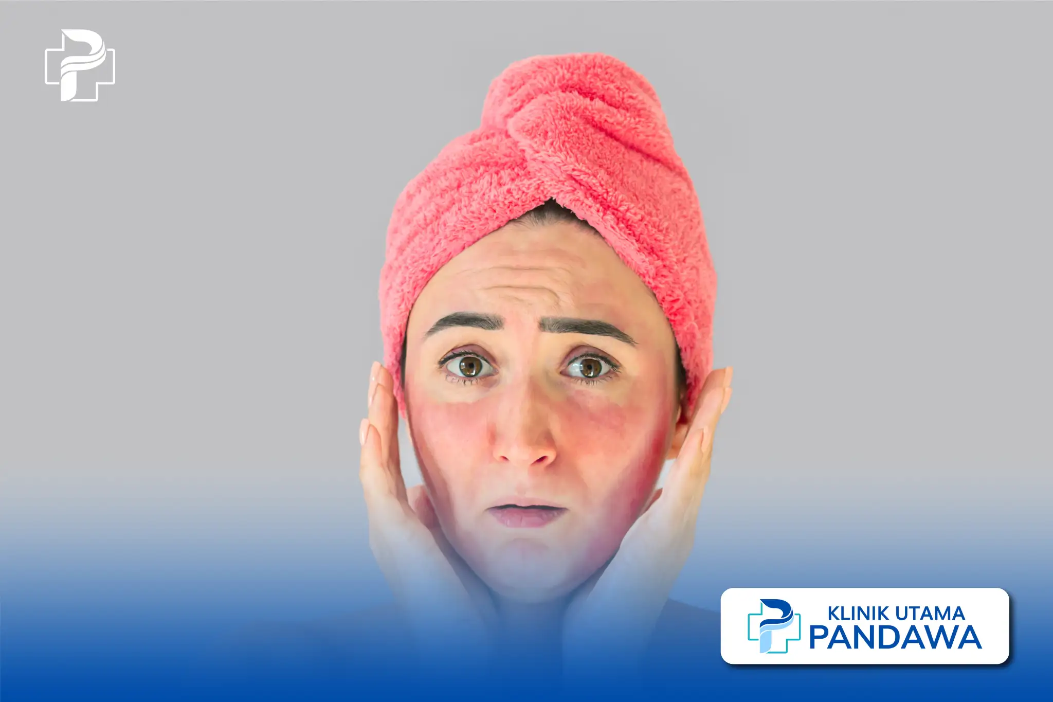 sunburn adalah