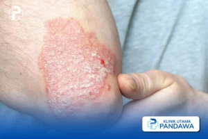 tanda psoriasis sembuh