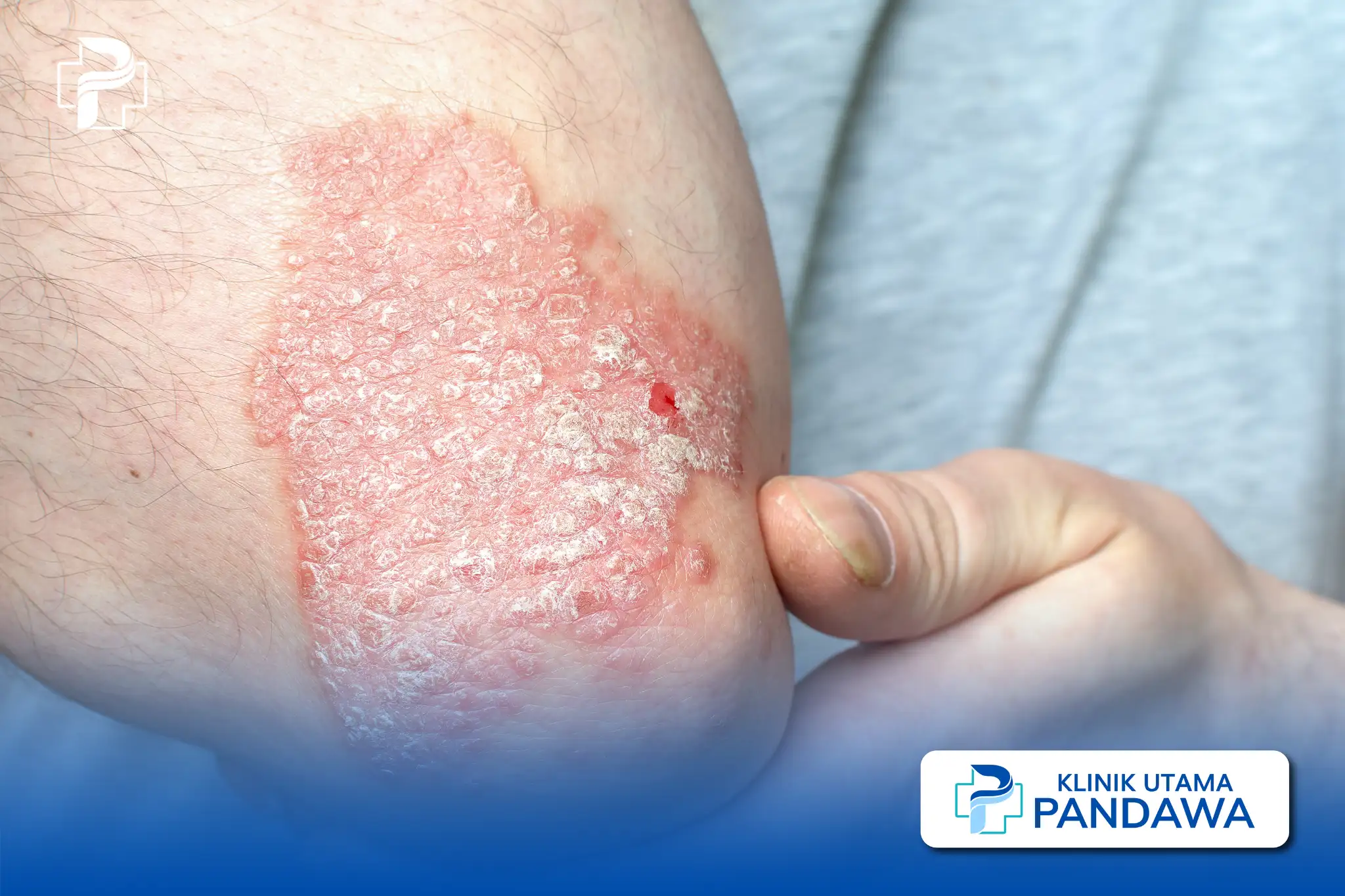 tanda psoriasis sembuh