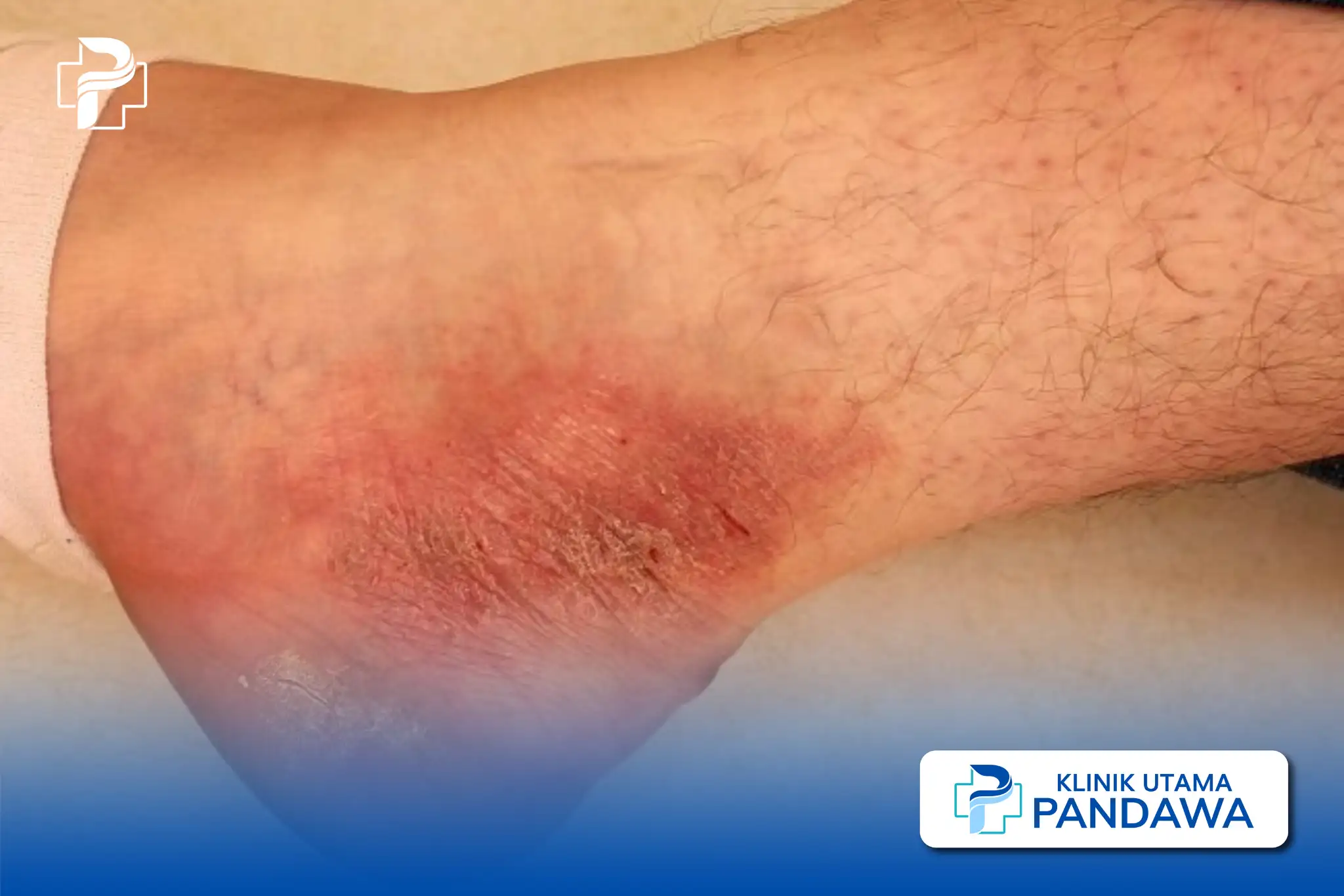 Neurodermatitis