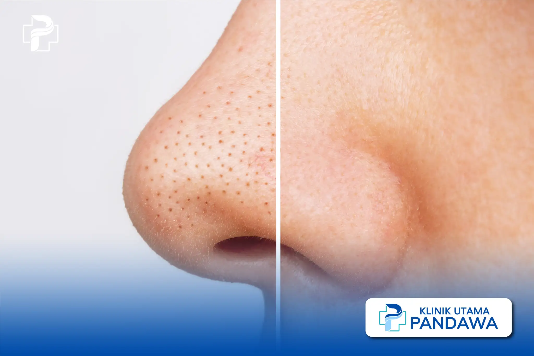 blackhead