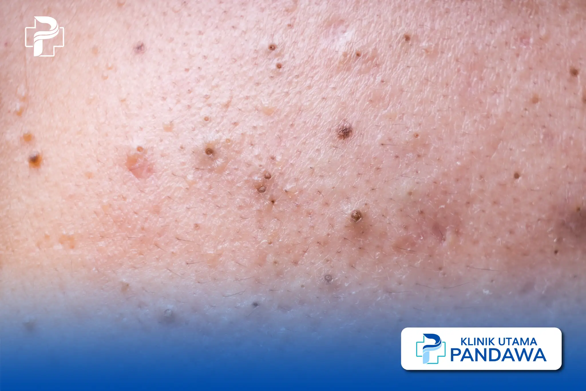 blackhead