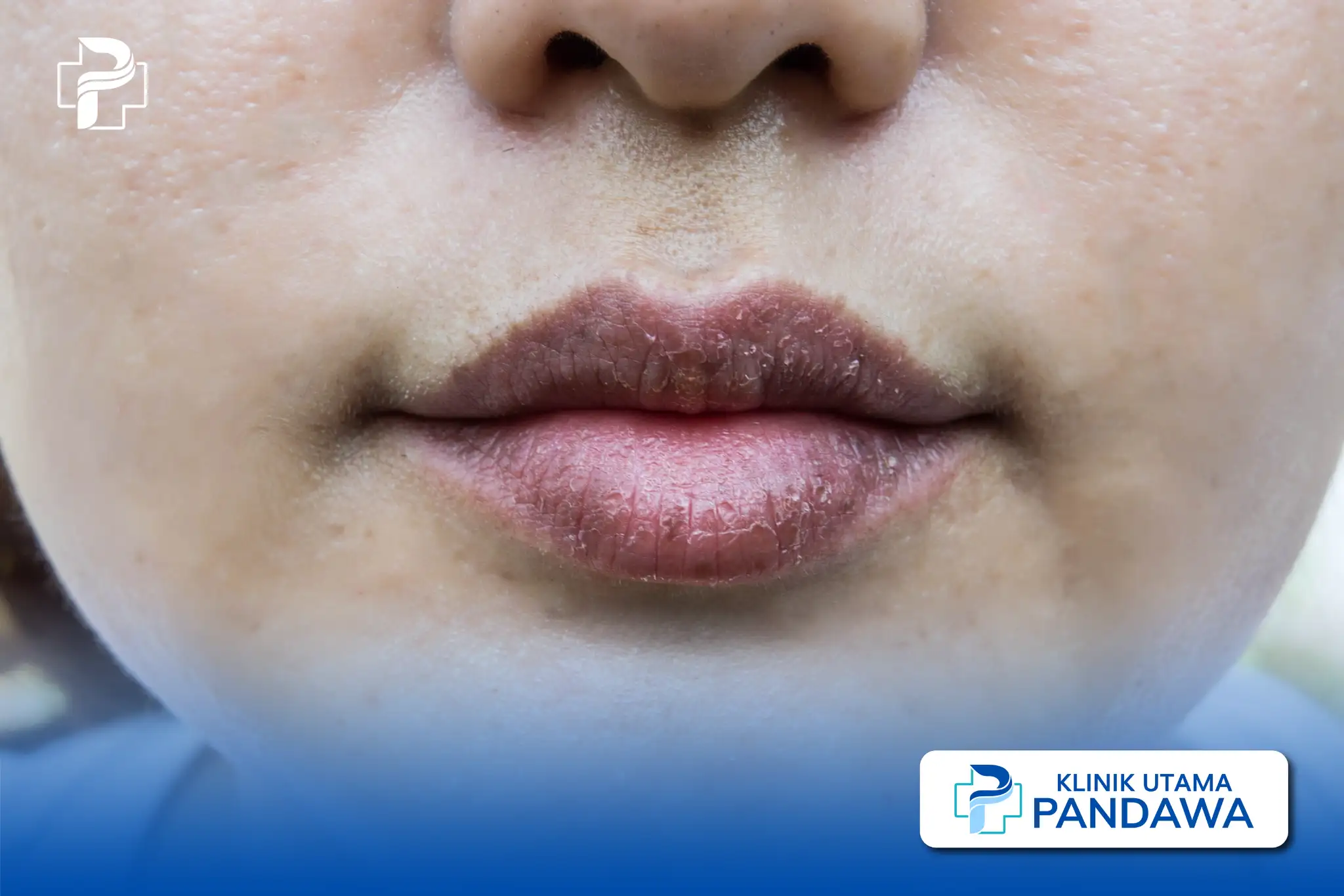 pinggir bibir hitam