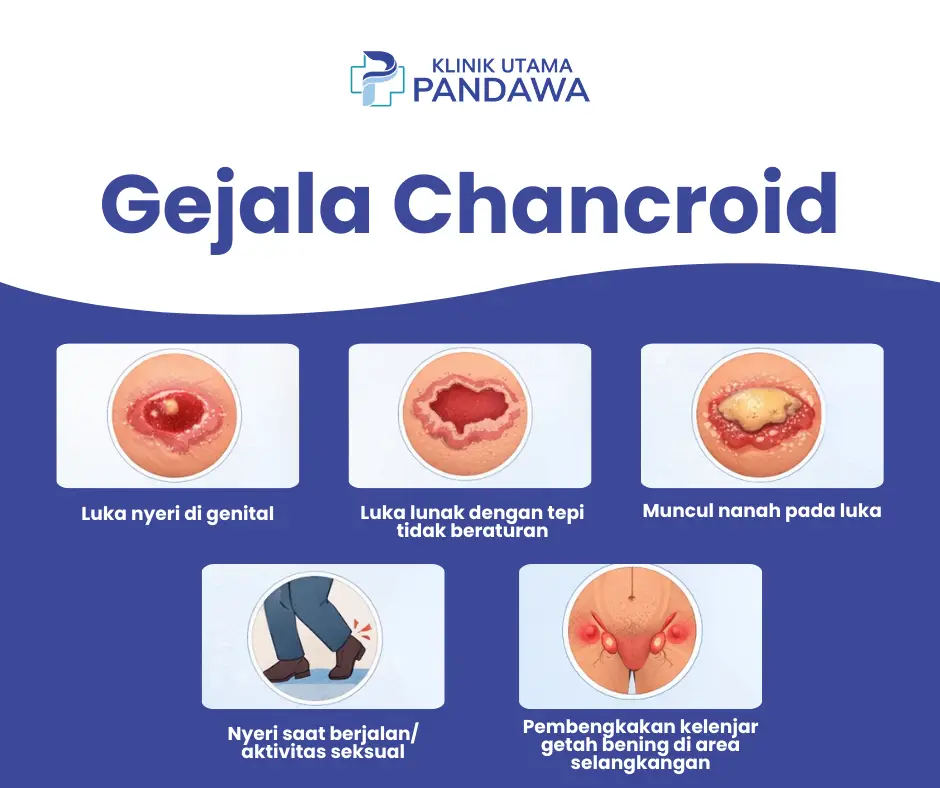 Gejala Chancroid