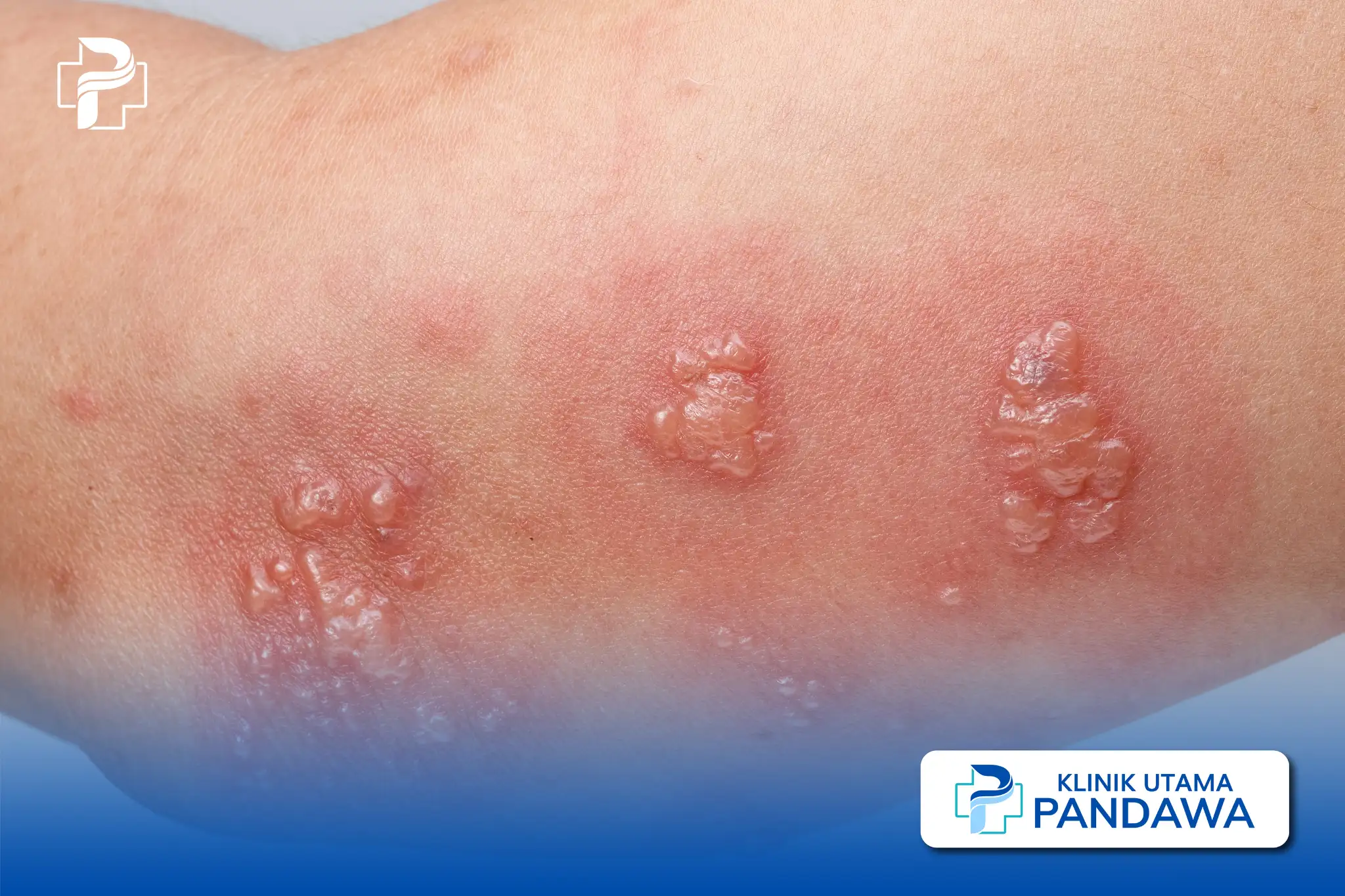 Herpes Neonatal