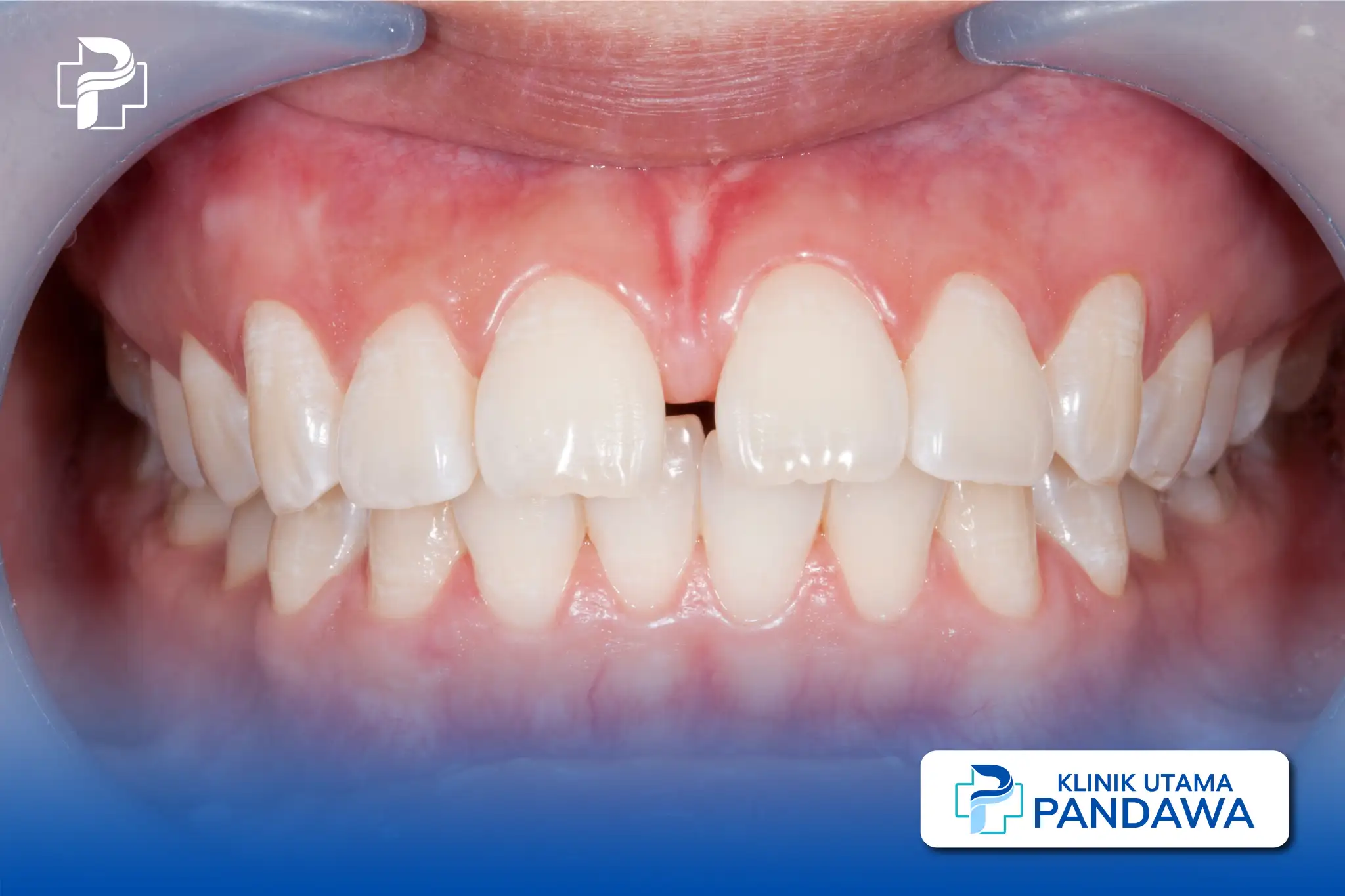 diastema gigi