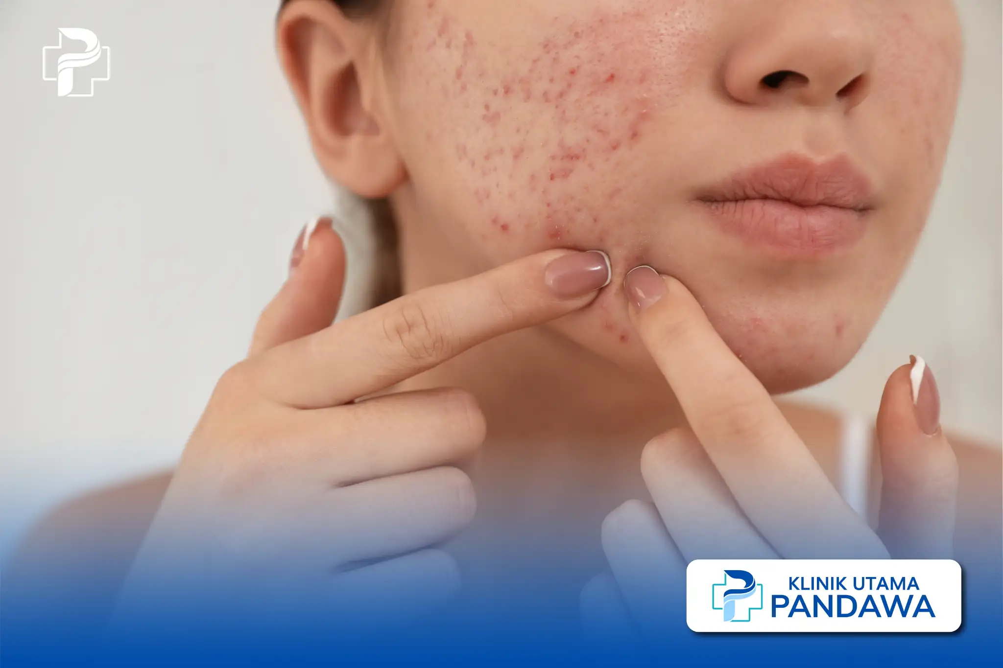 keloid bekas jerawat
