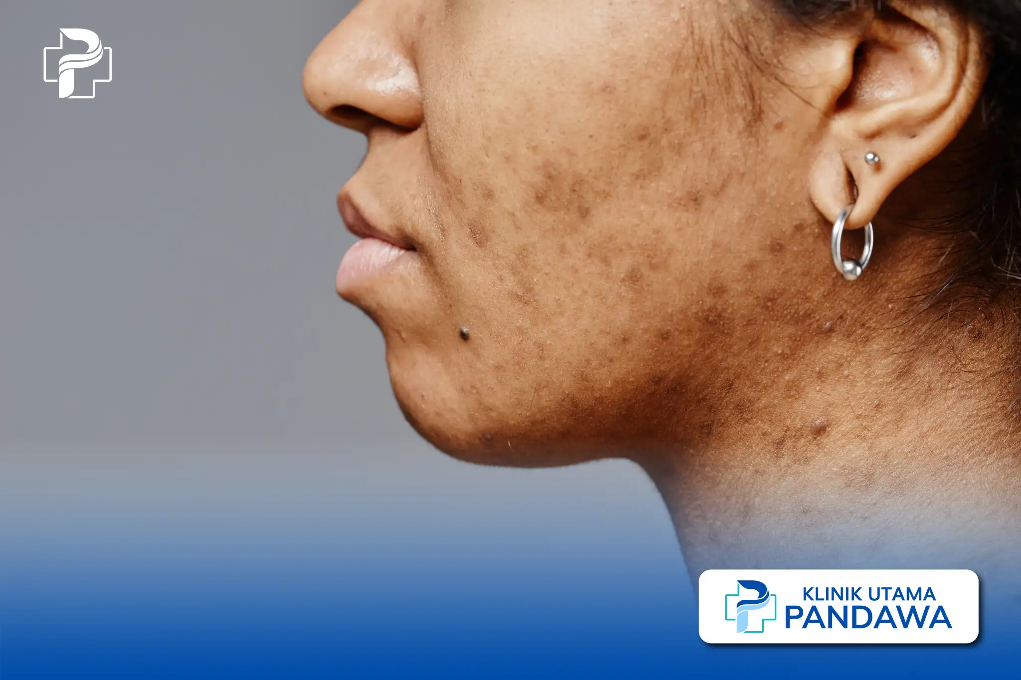 cara menghilangkan flek hitam dalam 1 jam