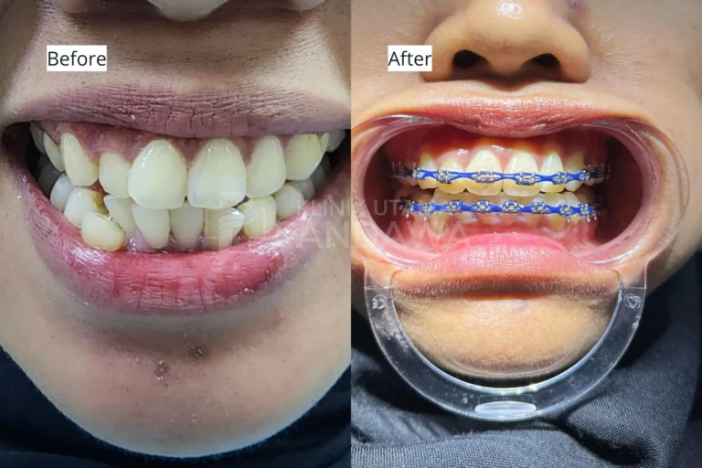 before after behel gigi