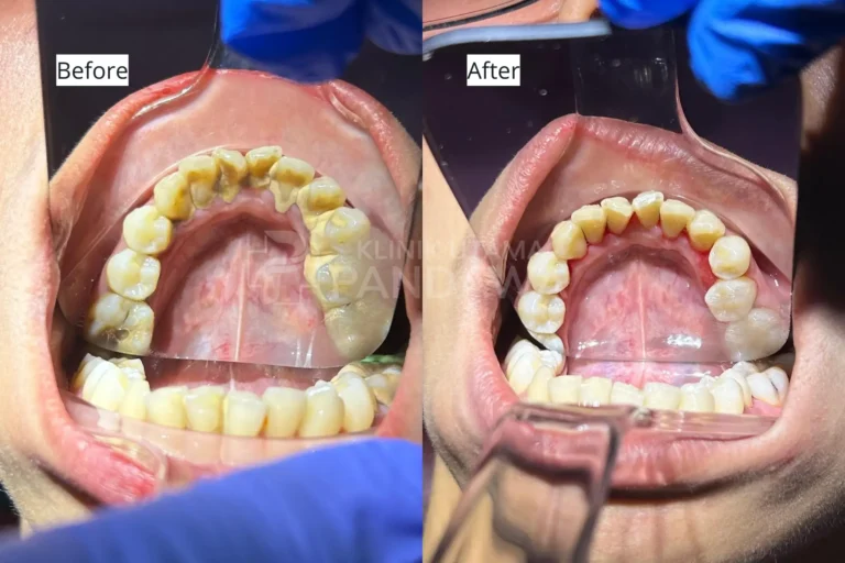 before after scaling KUP 1