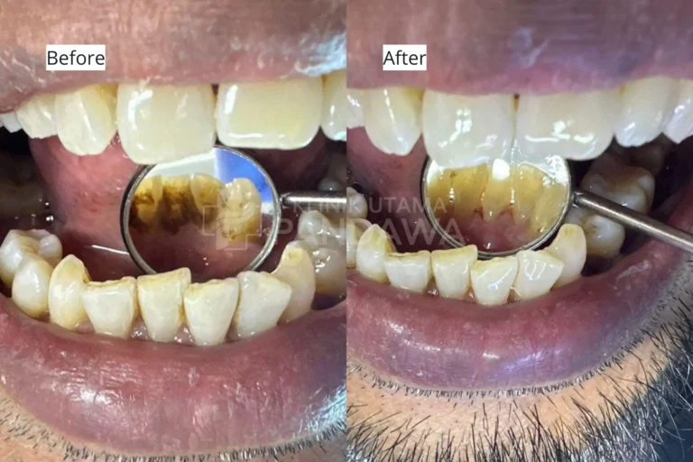 before after scaling gigi KUP