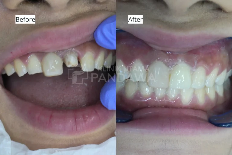 before after treatment gigi