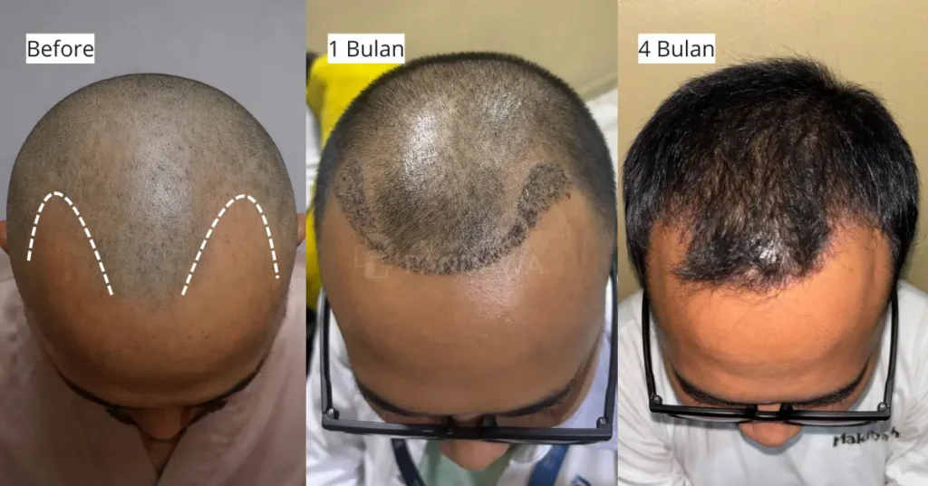 hair transplant - transplantasi rambut di klinik utama pandawa