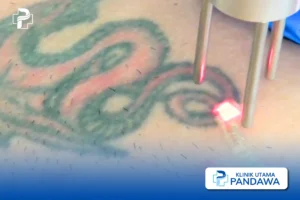 hapus tato - tattoo removal KUP