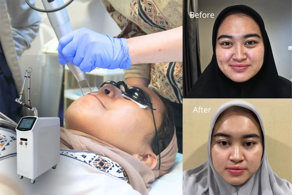 laser nd yag - penghilang flek